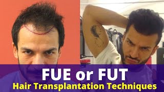 FUE or FUT Which technique to use for Hair Transplantation [upl. by Elegna]