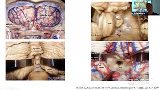 Neurosurgical Case Report FCN Tyumen Russia [upl. by Flossie]