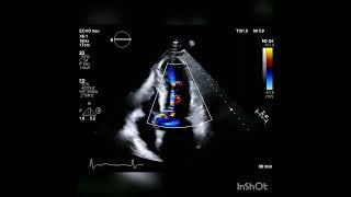 Hypertrophic cardiomyopathy with mid ventricular obstruction [upl. by Vittorio]