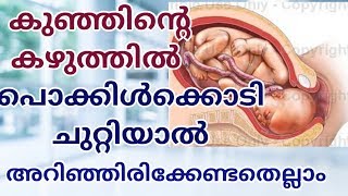 Cord around Neck at 33 Weeks in Pregnancy MalayalamNuchal Umbilical Cord [upl. by Raf34]