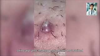 Ultimate Pimple Popping 2024 Powerful Acne Treatments [upl. by Strickler927]