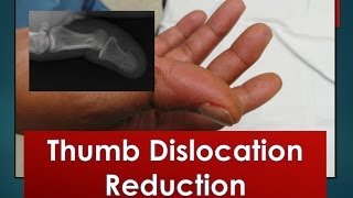 Thumb Dislocation Reduction [upl. by Dori]