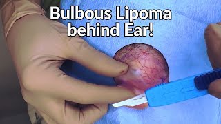 what the sigma dermatologist rizzles lipoma from behind the ear [upl. by Godewyn]