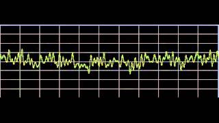 Sleep Apnea  Rife Frequencies [upl. by Shererd580]