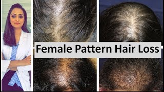 Hair loss in women  Female Pattern Hair Loss  causes amp treatment  Dermatologist [upl. by Wheaton]