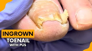 Ingrown Toenail Filled with Pus [upl. by Tillfourd570]