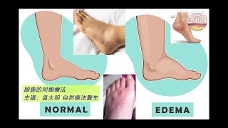 《自然療法與你》 EP679  「腳腫」的同類療法 [upl. by Kcaz]