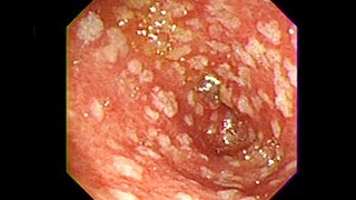 Gastric Intestinal Metaplasia  Chuyển sản ruột [upl. by Philbin557]