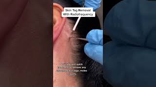 Skin Tag Removal With Radiofrequency  Quick amp Safe Treatment DRMEDISPA [upl. by Yatnoed]