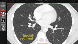 Lobar and Segmental Lung Anatomy on CT [upl. by Lavella863]