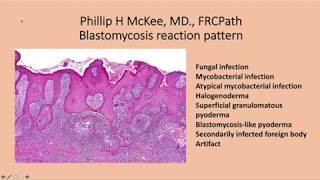 Blastomycosis reaction pattern Phillip H McKee 1 [upl. by Evered924]