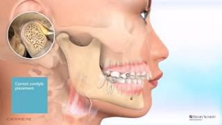 Carriere® Motion™ Appliance for Class II Patient Education Animation [upl. by Carolyn]