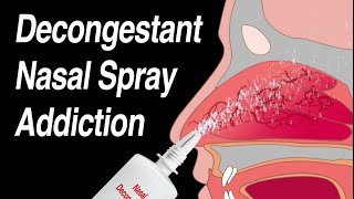 Decongestant Nasal Spray Addiction Afrin Zicam Sinex NeoSynephrine etc [upl. by Aciret]