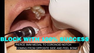 INFERIOR ALVEOLAR NERVE BLOCKINFERIOR ALVEOLAR BLOCKINDIRECT TECHNIQUE [upl. by Pathe]