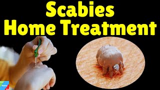 Scabies Home Treatment  Home Remedies for Scabies to Speed Up Treatment  How to Treat Scabies [upl. by Soane]