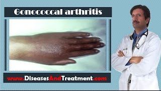 Gonococcal arthritis  Causes Diagnosis Symptoms Treatment Prognosis [upl. by Harland]