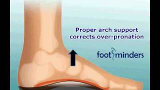 Foot Pain Due to Flat Feet and OverPronation An Easy Solution [upl. by Ymmit132]