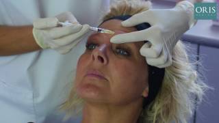 Botox Treatment for The Glabella Complex [upl. by Idelle631]