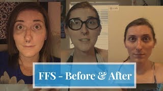 FFS Before amp After 7 Weeks PostOp  MTF Transgender I Facial Feminization Surgery [upl. by Ahsotan]