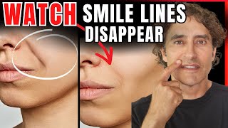 Nasolabial Folds DIY Hacks vs MedSpa Solutions [upl. by Tamsky]