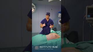 Cirugía plástica de lipoescultura con marcación abdominal [upl. by Deloris605]