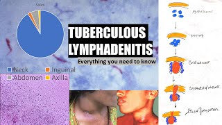 Tuberculous lymphadenitis  stages of cervical lymphadenitis  cold abscess  collar stud abscess [upl. by Sykleb884]