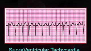 Introduction to EKG Rhythm Interpretation Part 3 [upl. by Alikat531]