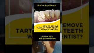 Removing Plaque From Teeth  How To Get Tartar off Teeth at Home tarta teeth dental [upl. by Htabmas]