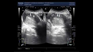 Ultrasound Video showing Two cases of Endometrial hyperplasia [upl. by Gnat]