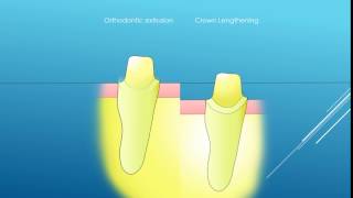 Crown Lenghtening VS Extrusion [upl. by Barthelemy]