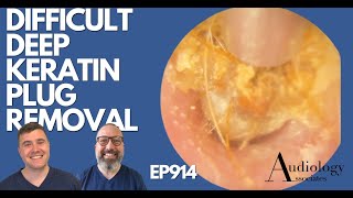 DIFFICULT DEEP KERATIN PLUG REMOVAL  EP914 [upl. by Merlina]