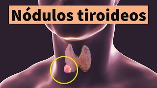 NÓDULOS TIROIDEOS síntomas diagnóstico tratamiento y prevención bulto o bola en el cuello [upl. by Gambrill]