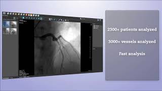 QFR no wire no adenosine for coronary physiology 2018 [upl. by Notyep]