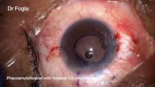 Combined Pterygium excision and Cataract surgery [upl. by Talanta855]