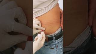 intramuscular injection injection into the gluteal muscle injection [upl. by Kissee]