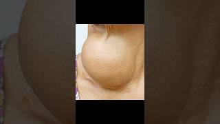 Goiter Huge Thyroid Growth in Someone’s Neck [upl. by Kenwrick]