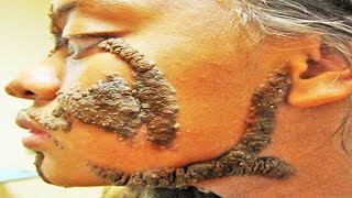 Sebaceous Blackheads Sebaceous Nevus Syndrome [upl. by Enimzaj873]