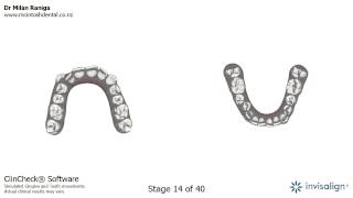 Invisalign animation showing tooth movement [upl. by Burrow895]