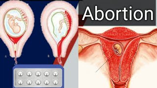 Abortion pill uses  garbhpat kaise kare home remedies  Side effects of misoprostol tablets [upl. by Anuaik]