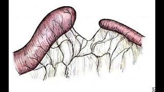 Jejunoileal atresia history and etiology [upl. by Nadabas]