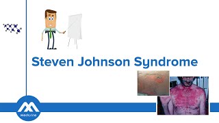 Stevens Johnson Syndrome [upl. by Nonna502]