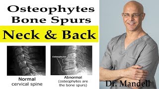 Do Bone SpursOsteophytes in Neck amp Back Go Away  Dr Alan Mandell DC [upl. by Toft212]