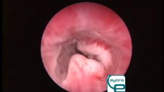 Veterinary Endoscopy Transitional cell carcinoma in dog urethrocystoscopy [upl. by Yanttirb]