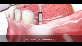 Prothèse amovible CLIPSÉ sur implant bouton pression [upl. by Rheims]