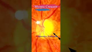 Myopic Crescent  Fundus Photography  Tesselations  Short Video 100 [upl. by Helbonnah158]