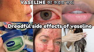 ❌Dreadful side effects of Vaselinedont use before watchखुद को खराब न करेright use to vaseline [upl. by Erdried292]