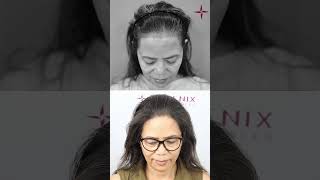 Hair Transplant For Women EugenixHairSciencesofficial [upl. by Greabe]