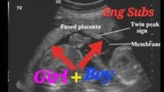 Anterior placenta means baby boy or girl  Anterior placenta baby gender  Boy n Girl Twin Pregnancy [upl. by Aroon651]