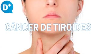 Cáncer de tiroides Qué es por qué se produce y cómo se trata [upl. by Yojenitsirk]