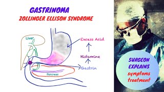 Gastrinoma  Zollinger Ellison Syndrome [upl. by Hephzipa]